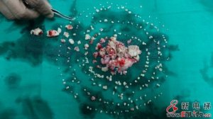 印度少年牙疼难耐 开刀从嘴中取出232颗牙(图)